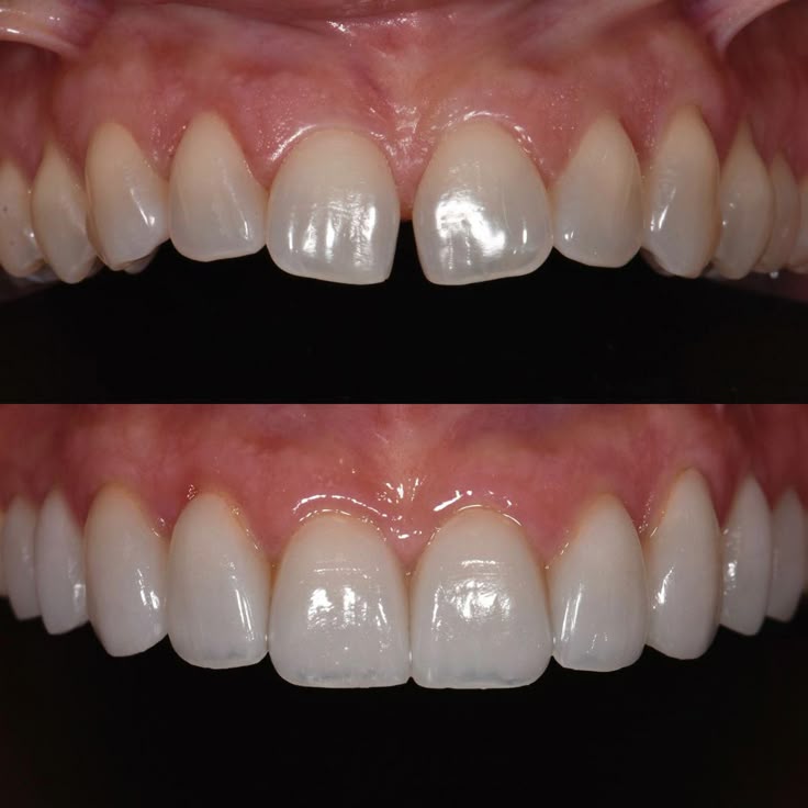 Antes y después dental