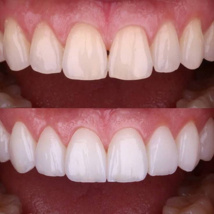 Antes y después dental