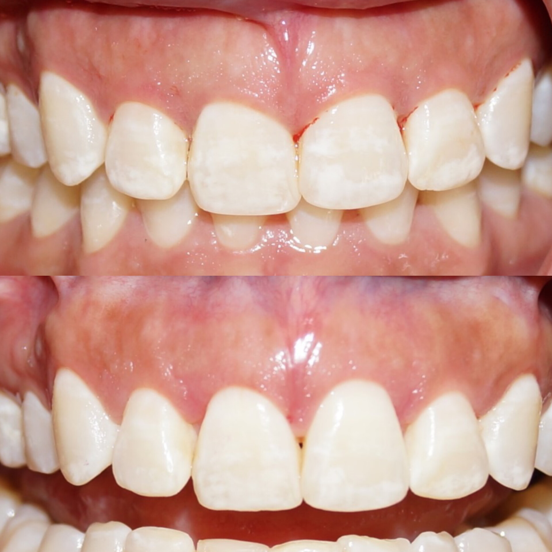 Antes y después dental